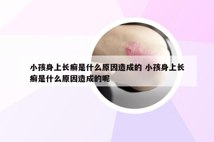 小孩身上长癣是什么原因造成的 小孩身上长癣是什么原因造成的呢