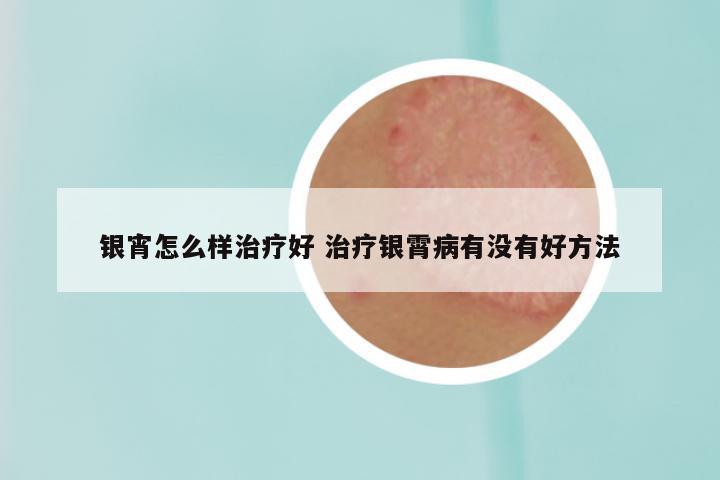 银宵怎么样治疗好 治疗银霄病有没有好方法
