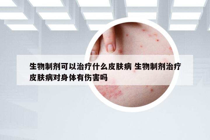 生物制剂可以治疗什么皮肤病 生物制剂治疗皮肤病对身体有伤害吗