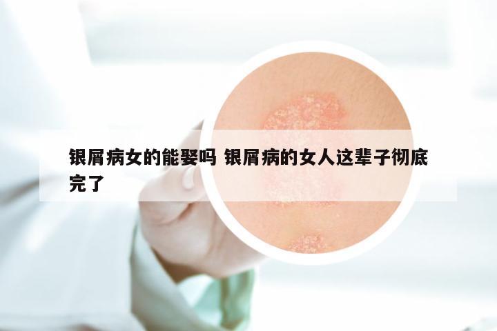 银屑病女的能娶吗 银屑病的女人这辈子彻底完了