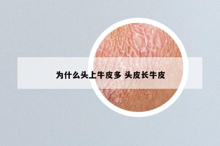 为什么头上牛皮多 头皮长牛皮