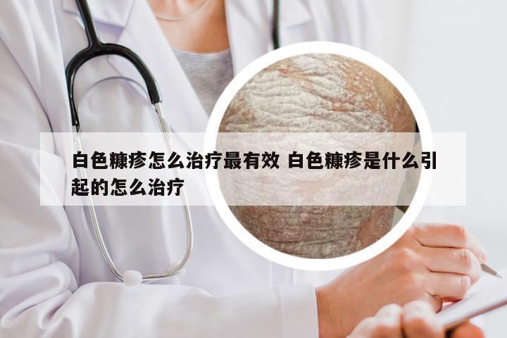 白色糠疹怎么治疗最有效 白色糠疹是什么引起的怎么治疗