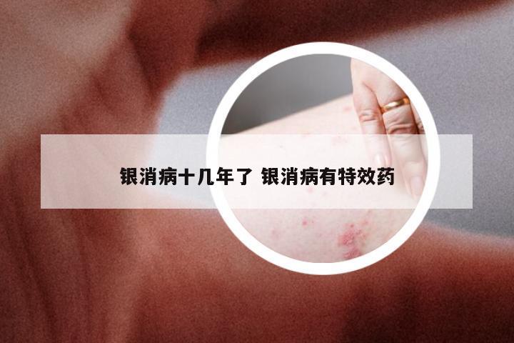 银消病十几年了 银消病有特效药