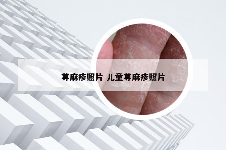 荨麻疹照片 儿童荨麻疹照片