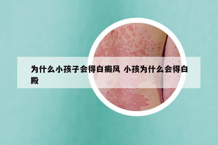 为什么小孩子会得白癜风 小孩为什么会得白殿