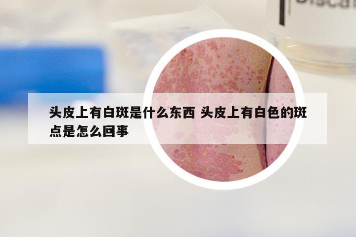 头皮上有白斑是什么东西 头皮上有白色的斑点是怎么回事