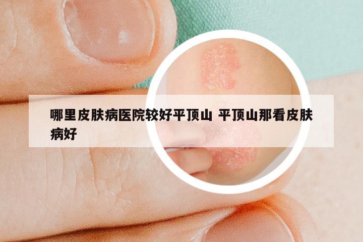 哪里皮肤病医院较好平顶山 平顶山那看皮肤病好