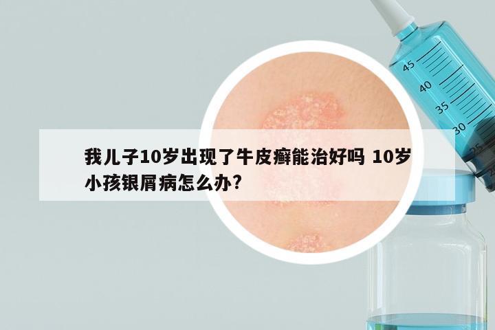 我儿子10岁出现了牛皮癣能治好吗 10岁小孩银屑病怎么办?