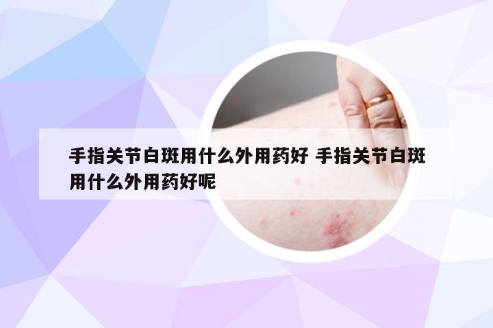 手指关节白斑用什么外用药好 手指关节白斑用什么外用药好呢