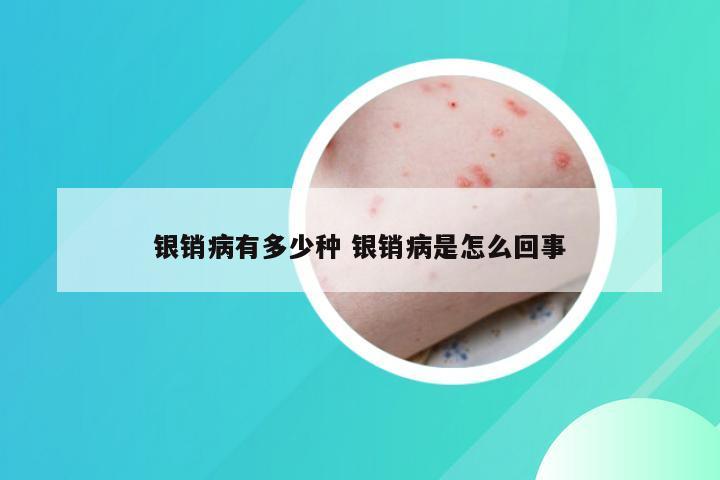 银销病有多少种 银销病是怎么回事
