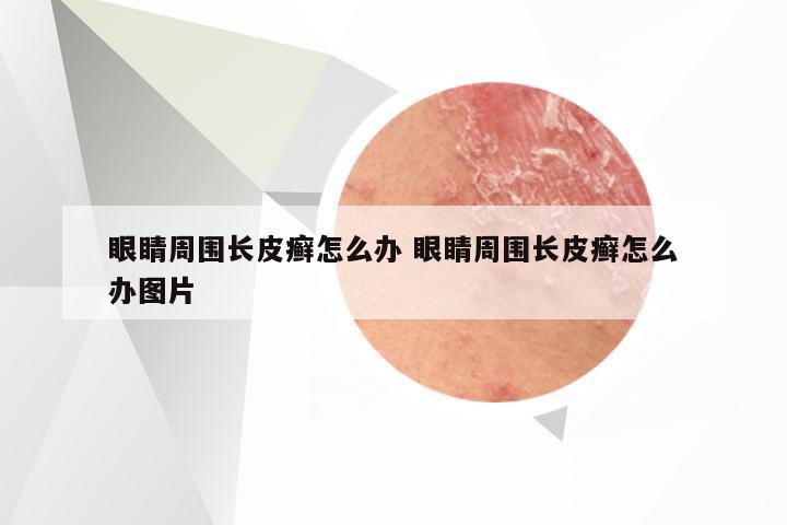 眼睛周围长皮癣怎么办 眼睛周围长皮癣怎么办图片