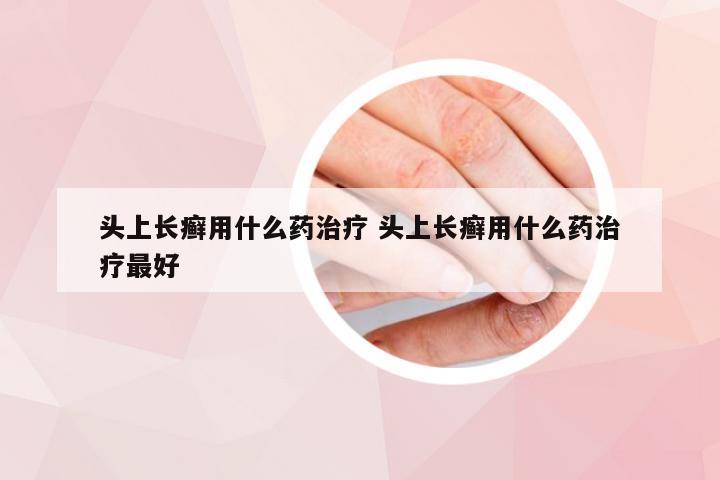 头上长癣用什么药治疗 头上长癣用什么药治疗最好