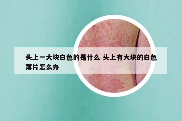 头上一大块白色的是什么 头上有大块的白色薄片怎么办