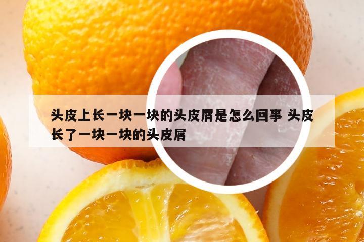 头皮上长一块一块的头皮屑是怎么回事 头皮长了一块一块的头皮屑