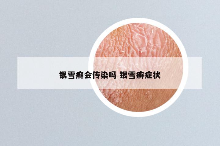 银雪癣会传染吗 银雪癣症状