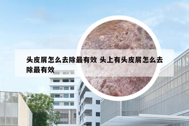 头皮屑怎么去除最有效 头上有头皮屑怎么去除最有效