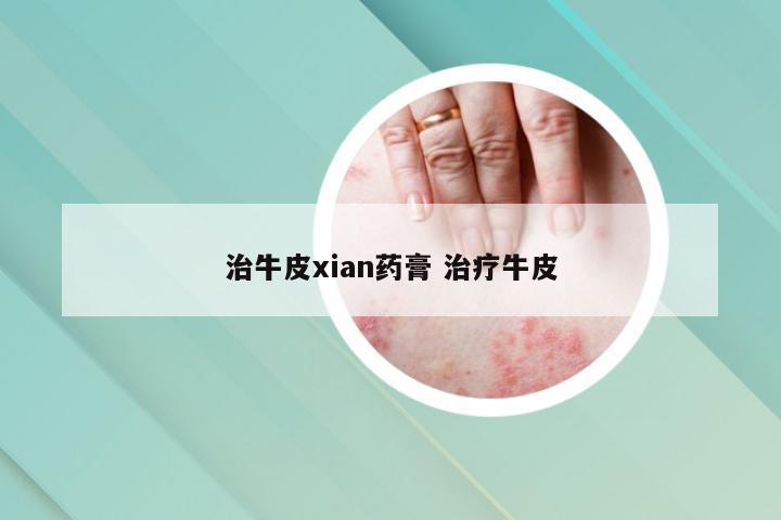 治牛皮xian药膏 治疗牛皮