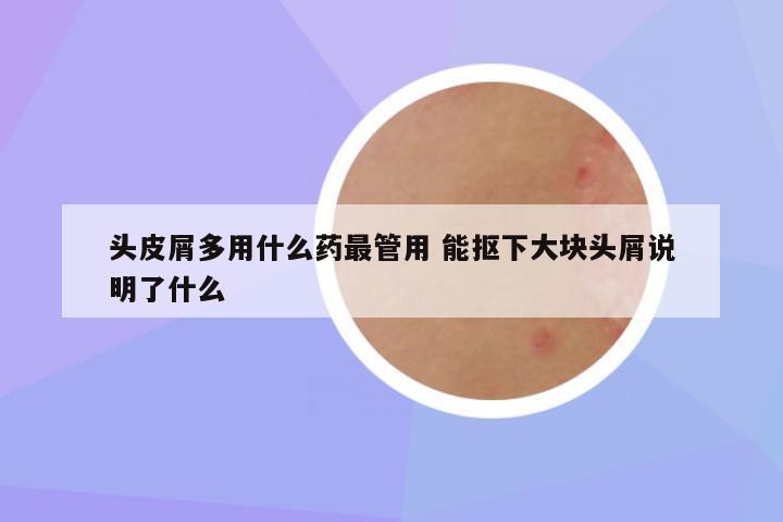 头皮屑多用什么药最管用 能抠下大块头屑说明了什么