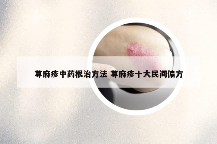 荨麻疹中药根治方法 荨麻疹十大民间偏方