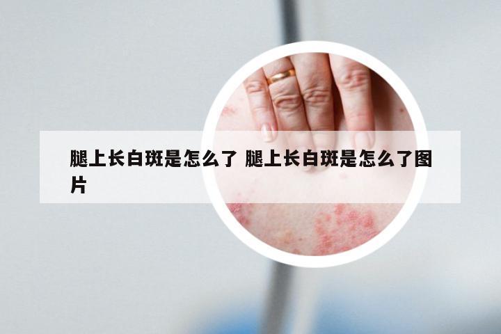 腿上长白斑是怎么了 腿上长白斑是怎么了图片