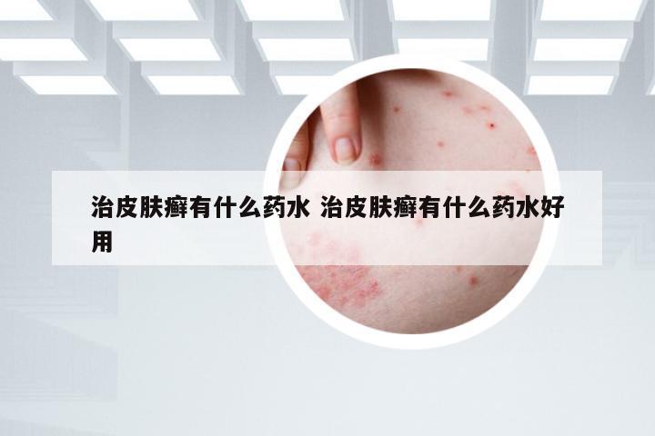 治皮肤癣有什么药水 治皮肤癣有什么药水好用