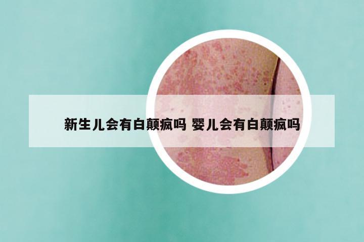新生儿会有白颠疯吗 婴儿会有白颠疯吗