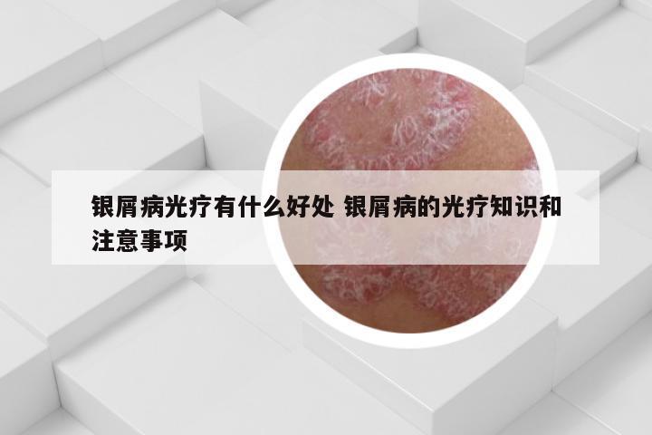 银屑病光疗有什么好处 银屑病的光疗知识和注意事项