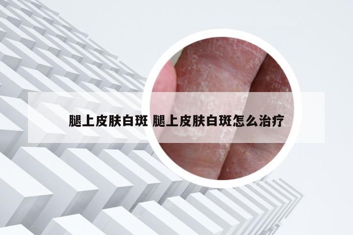 腿上皮肤白斑 腿上皮肤白斑怎么治疗