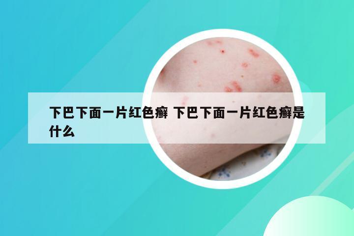 下巴下面一片红色癣 下巴下面一片红色癣是什么
