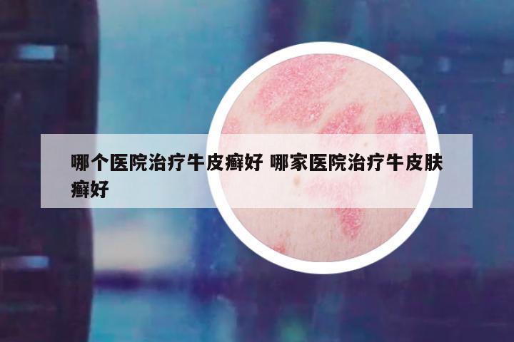 哪个医院治疗牛皮癣好 哪家医院治疗牛皮肤癣好