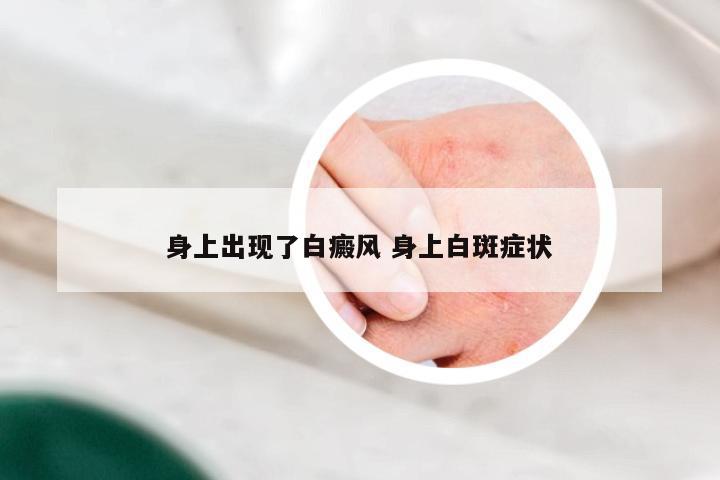 身上出现了白癜风 身上白斑症状
