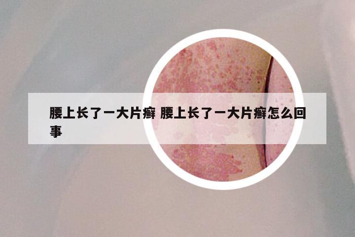 腰上长了一大片癣 腰上长了一大片癣怎么回事