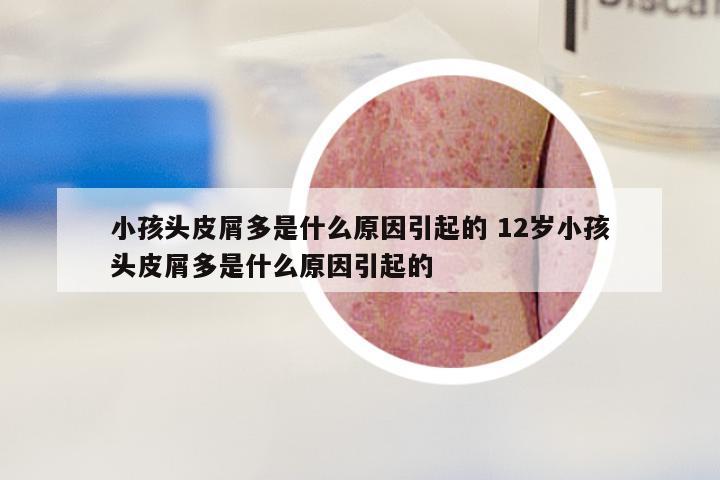 小孩头皮屑多是什么原因引起的 12岁小孩头皮屑多是什么原因引起的