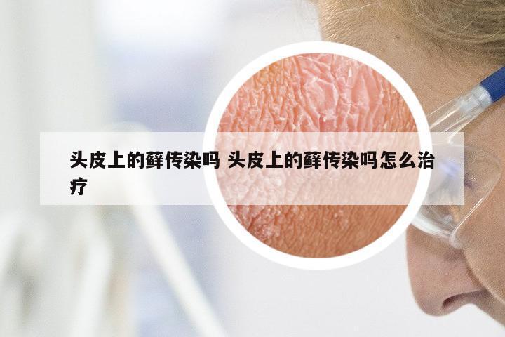头皮上的藓传染吗 头皮上的藓传染吗怎么治疗