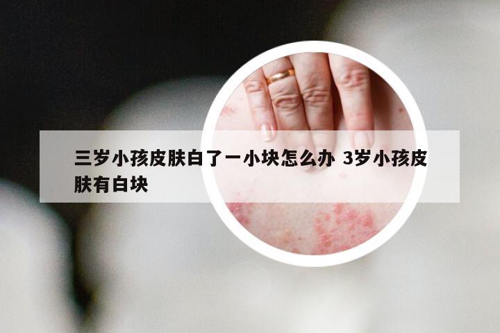 三岁小孩皮肤白了一小块怎么办 3岁小孩皮肤有白块