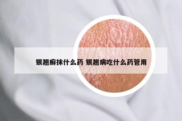 银翘癣抹什么药 银翘病吃什么药管用