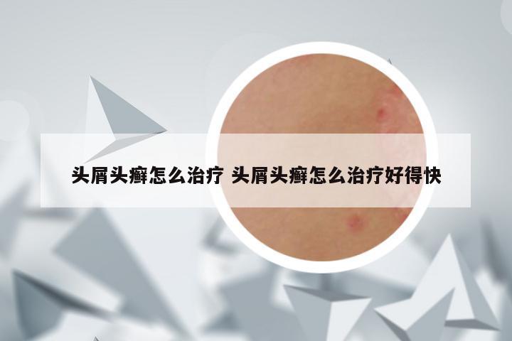 头屑头癣怎么治疗 头屑头癣怎么治疗好得快