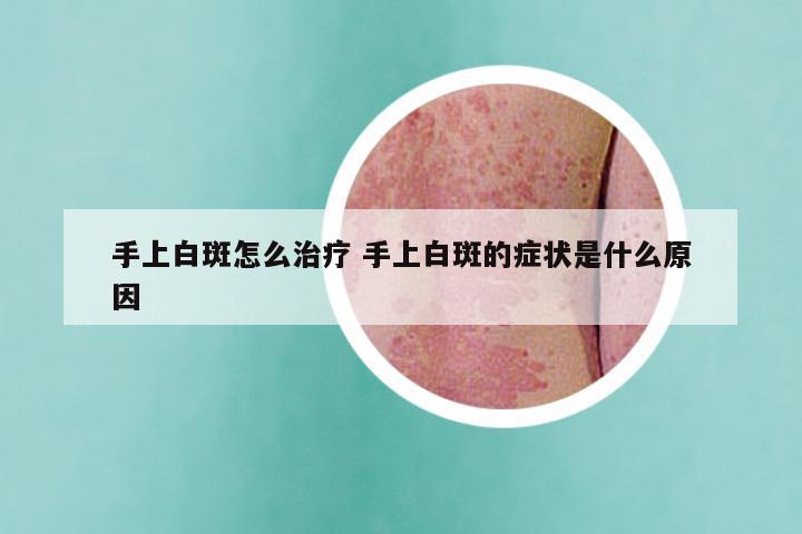 手上白斑怎么治疗 手上白斑的症状是什么原因