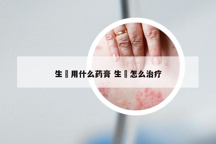 生廯用什么药膏 生廯怎么治疗