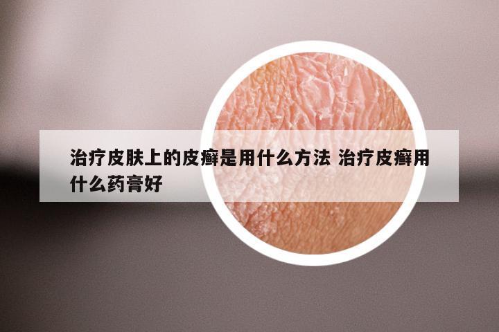 治疗皮肤上的皮癣是用什么方法 治疗皮癣用什么药膏好