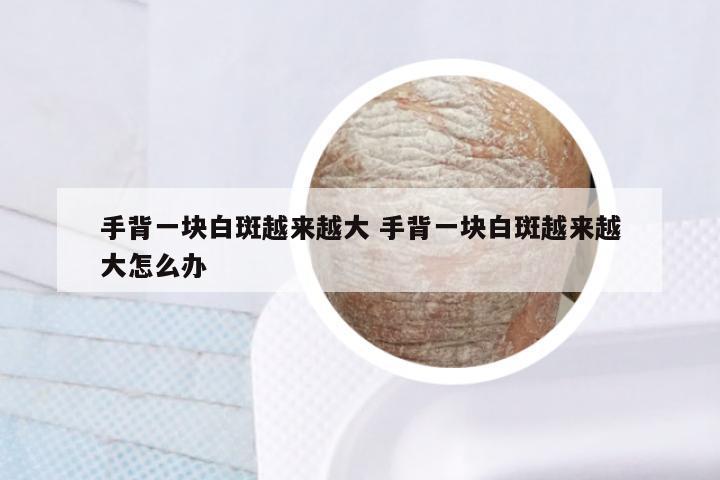手背一块白斑越来越大 手背一块白斑越来越大怎么办