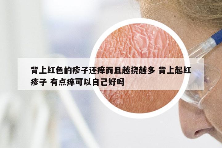背上红色的疹子还痒而且越挠越多 背上起红疹子 有点痒可以自己好吗