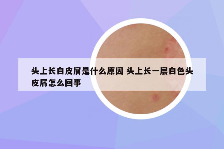 头上长白皮屑是什么原因 头上长一层白色头皮屑怎么回事