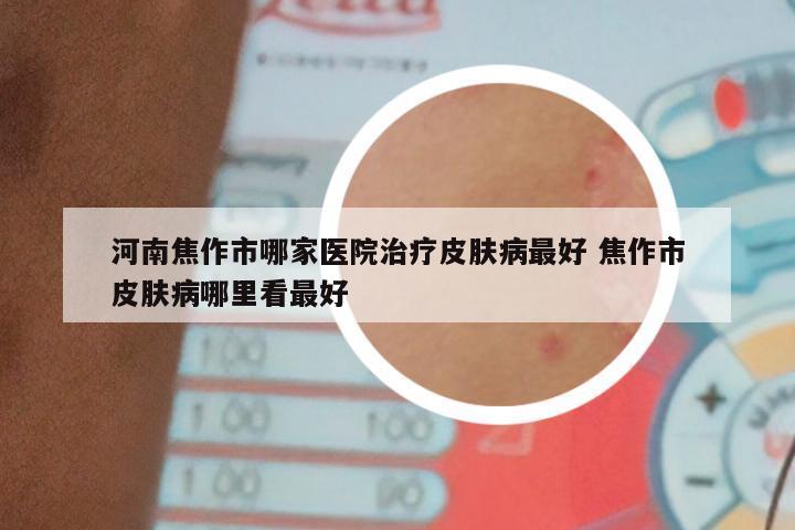 河南焦作市哪家医院治疗皮肤病最好 焦作市皮肤病哪里看最好