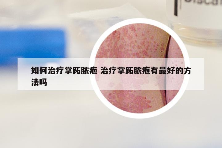 如何治疗掌跖脓疱 治疗掌跖脓疱有最好的方法吗