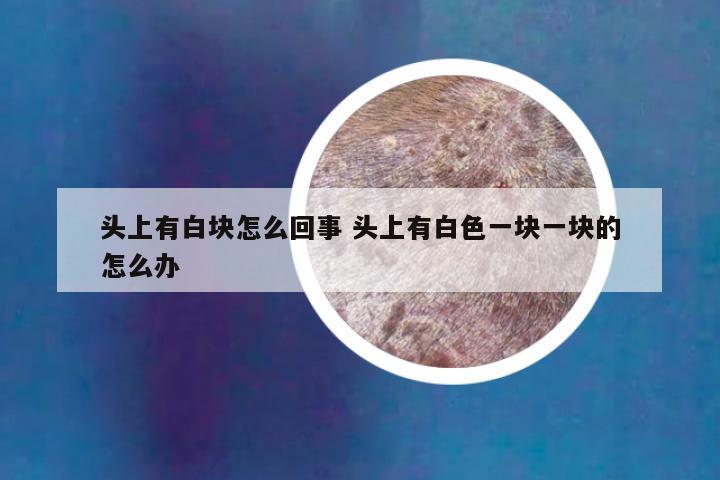 头上有白块怎么回事 头上有白色一块一块的怎么办