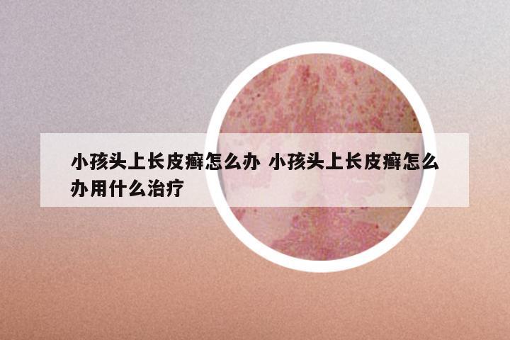 小孩头上长皮癣怎么办 小孩头上长皮癣怎么办用什么治疗