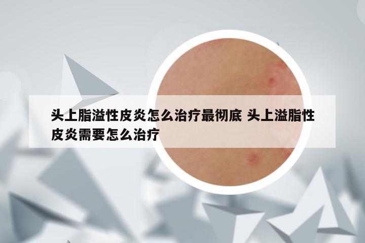 头上脂溢性皮炎怎么治疗最彻底 头上溢脂性皮炎需要怎么治疗