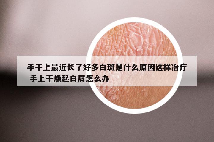 手干上最近长了好多白斑是什么原因这样冶疗 手上干燥起白屑怎么办