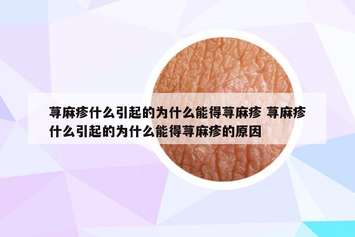 荨麻疹什么引起的为什么能得荨麻疹 荨麻疹什么引起的为什么能得荨麻疹的原因
